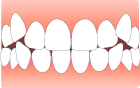 歯がデコボコ