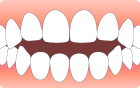 前歯がうまく閉じられない