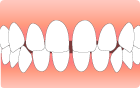 すきっ歯で悩んでいる